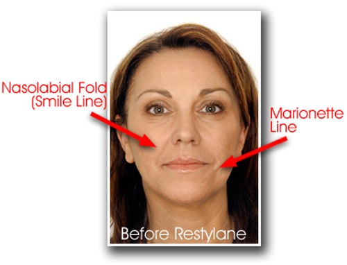 restylane-before